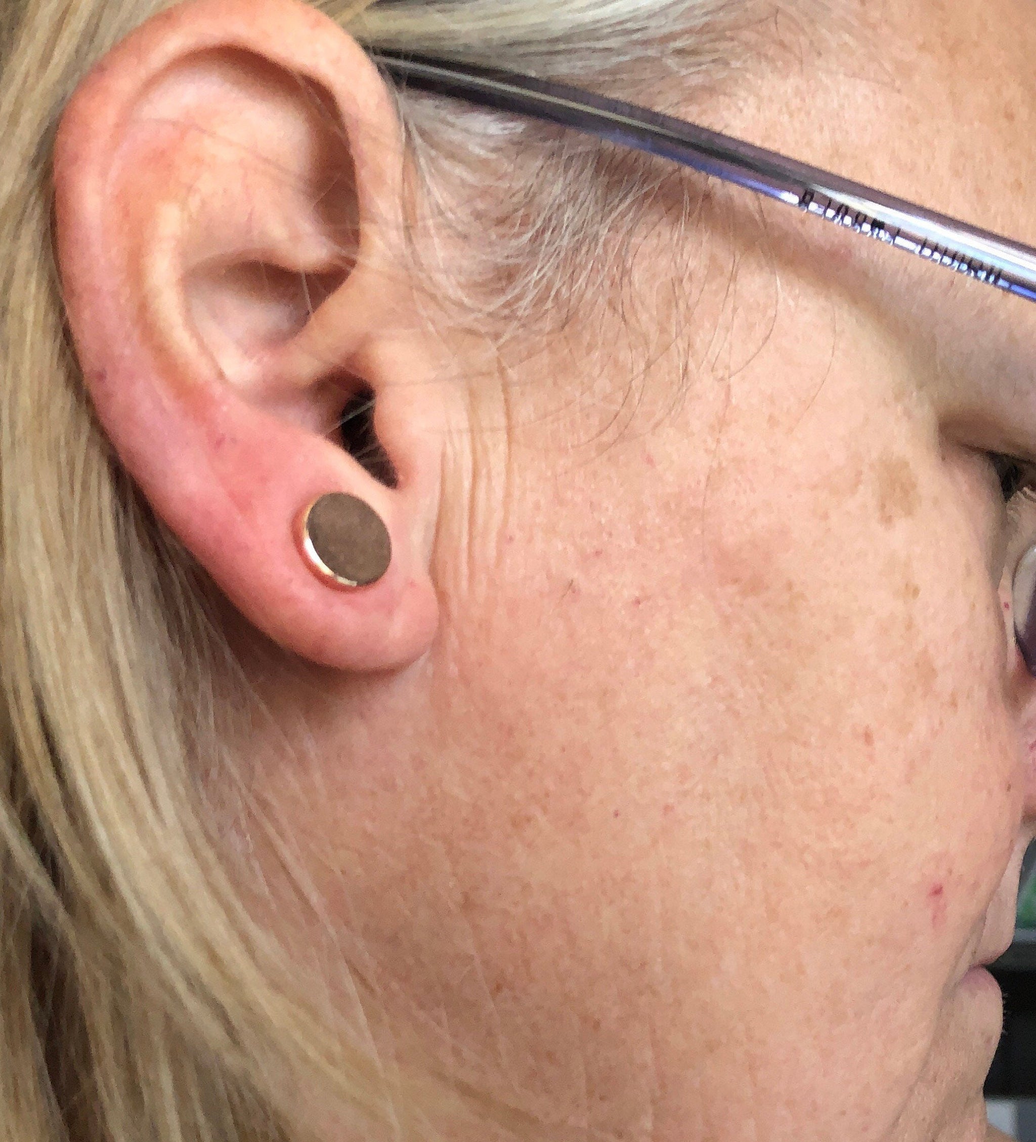 Ear Keloid Compression Clip Pair of Clip on Earrings for Post-op Keloid  Treatment 