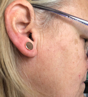 Gold keloid pressure earrings • Magnetic earrings clip on ear rings • Cheloid compression earring • Post Op treatment keloid scars • Magnet